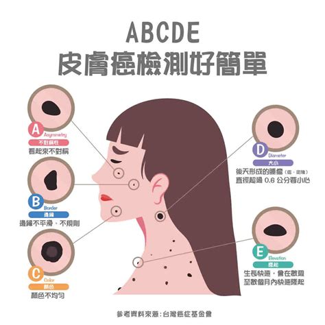 乳頭長痣|健康網》長痣＝皮膚癌？ 醫提7症狀：善用ABCDE原。